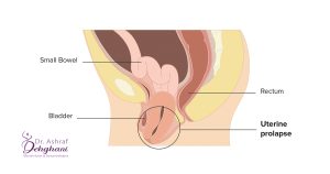 افتادگی رحم چیست